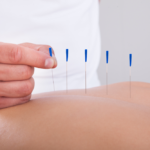 Profissional de acupuntura fazendo o seu trabalho