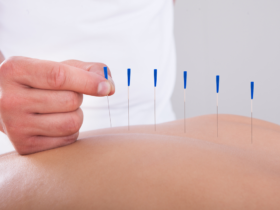 Profissional de acupuntura fazendo o seu trabalho