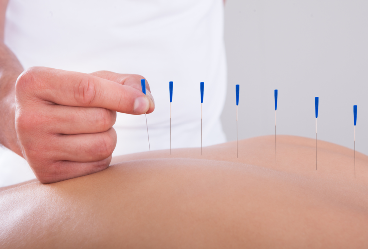Profissional de acupuntura fazendo o seu trabalho