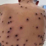 Lesões causadas por Mpox - Foto: Divulgação