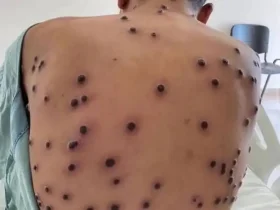 Lesões causadas por Mpox - Foto: Divulgação